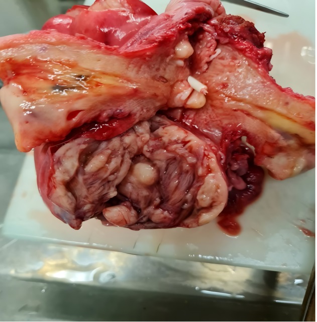 Macroscopic report of Uterine ALLM 1