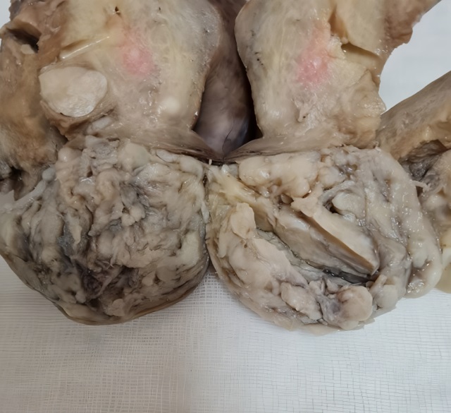 Macroscopic report of Uterine ALLM 3