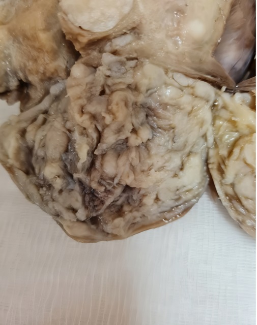 Macroscopic report of Uterine ALLM 4
