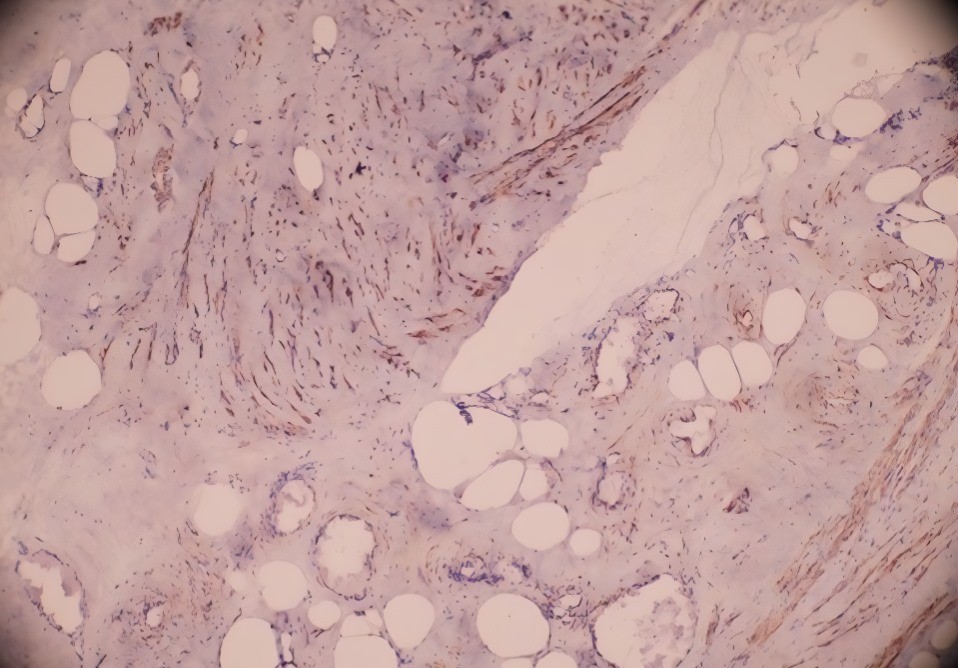 Microscopic Report: Smooth muscle component strongly stained  with SmMA antibody in immunohistochemical examination.