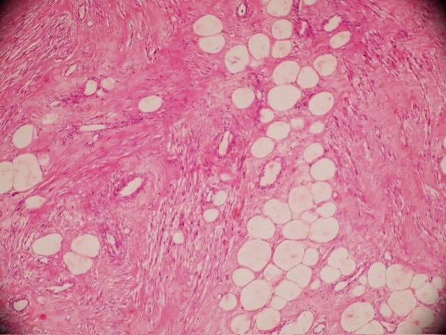 H&E stained microscopic section of angiolipoleiomyoma showing smooth muscle, mature lipocytes and vasculer structures.